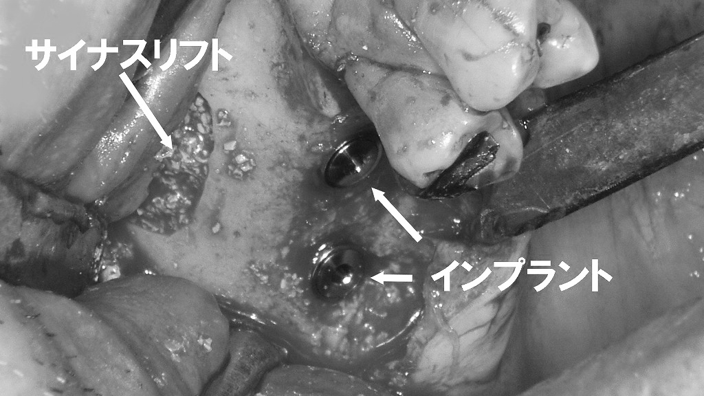 サイナスリフト
