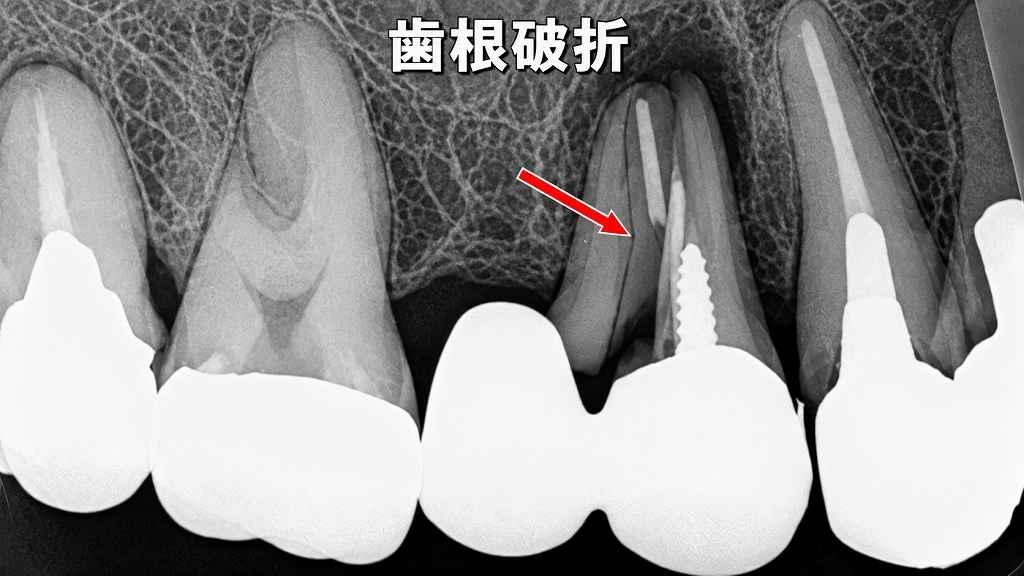 ブリッジのリスク：4番に負担集中：歯根破折