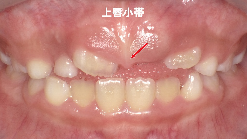 上唇小帯は必ず切らなくてよい？前歯が生えるまで様子を見るという選択肢