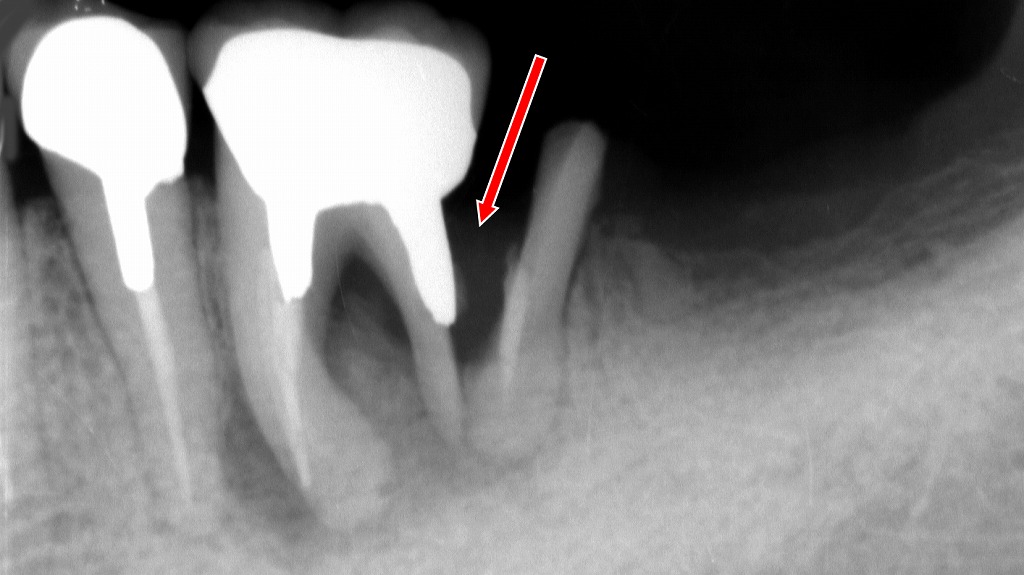 抜歯が必要なケース:歯根破折や重度感染