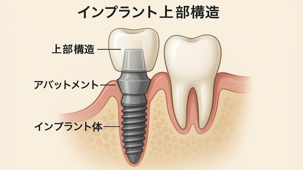インプラントの上部構造