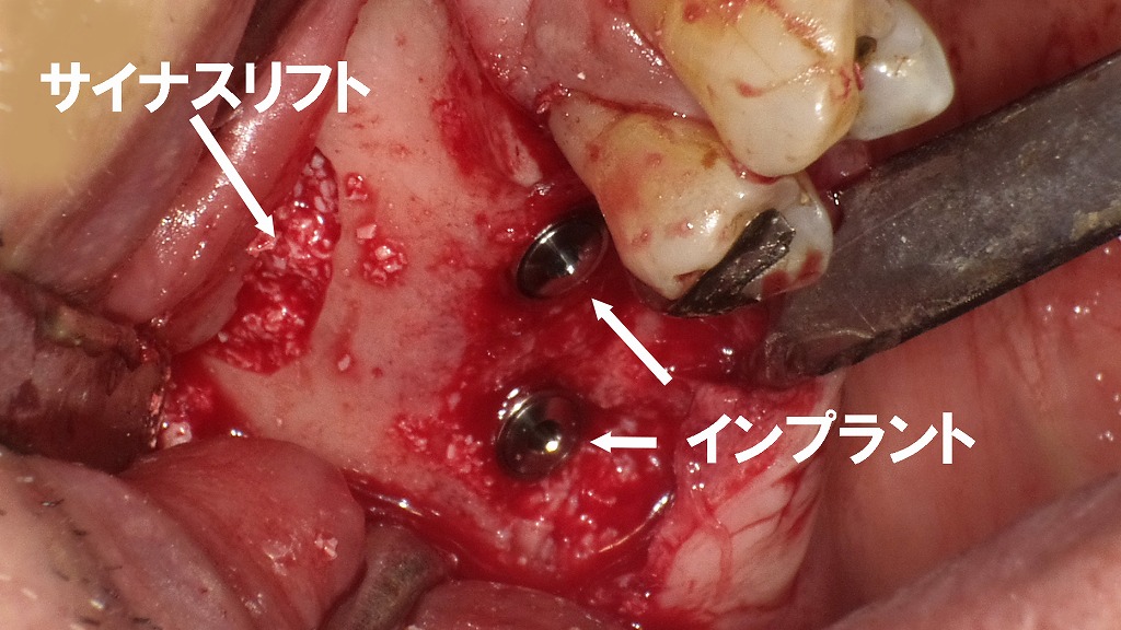 サイナスリフト