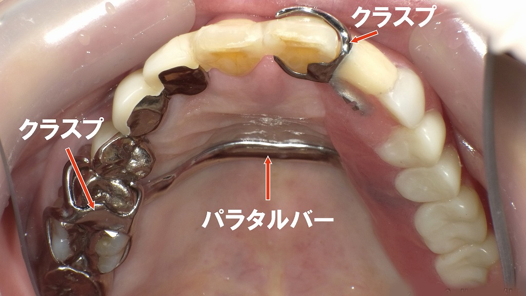 ２枚目（口蓋側：入れ歯の写真）