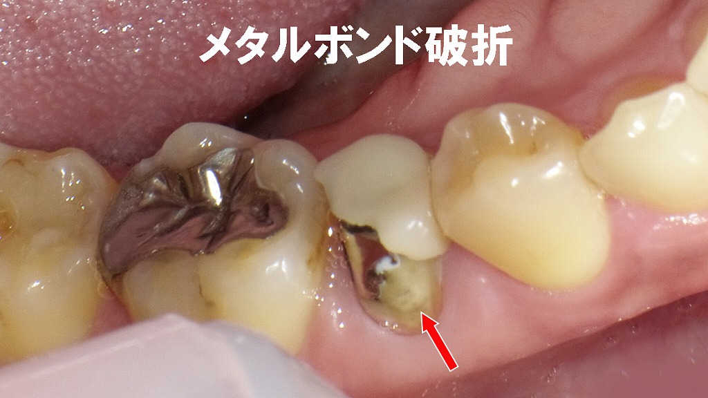 メタルボンド破折