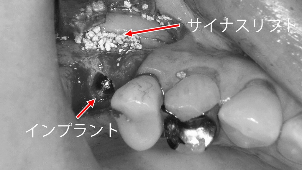 上顎６番相当部のインプラント埋入とサイナスリフト