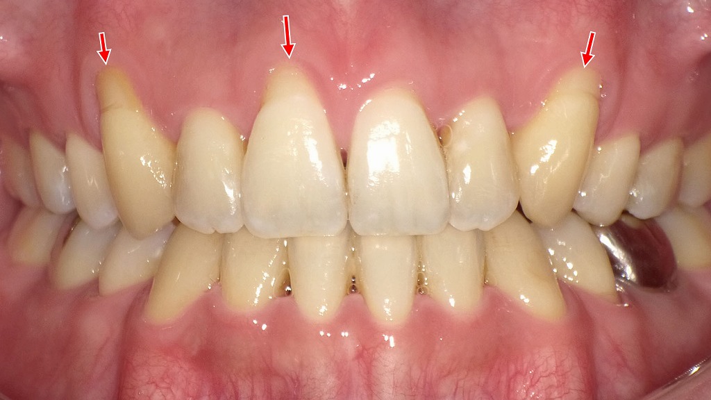 ホワイトニングでにしみる原因？歯根露出と知覚過敏
