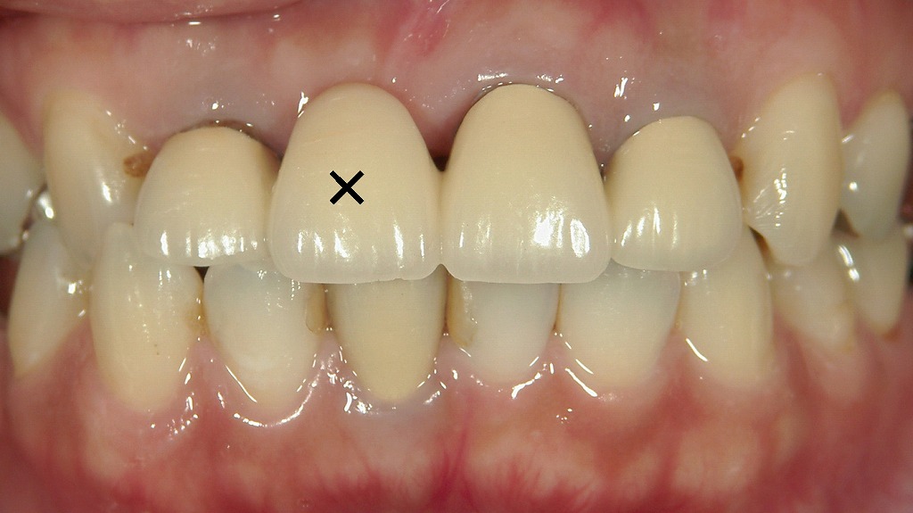 右上1番欠損に対する抜歯後のメタルボンドブリッジ治療