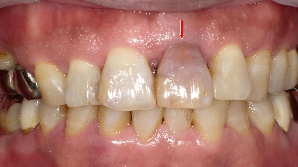 中央の歯（矢印部分）が灰色〜茶色に変色しています。これは外傷や深い虫歯などで神経が壊死し、内部の血液成分が歯の色に影響した典型的な状態です。