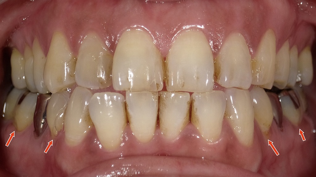 1枚目：ホワイトニング前