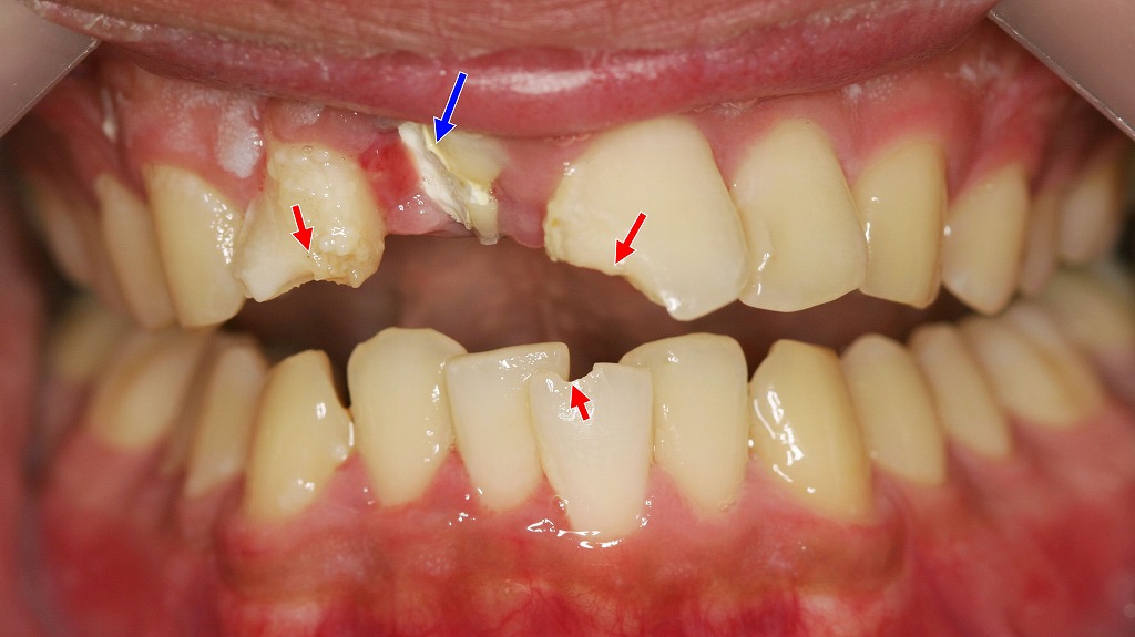 外傷により歯を強くぶつけた症例(前歯部)