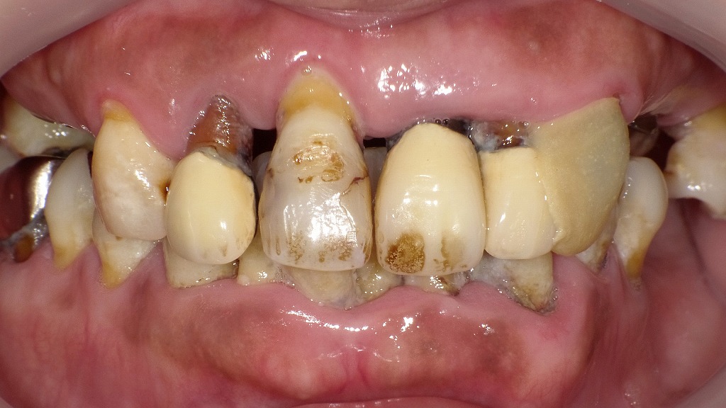 歯周病の真の原因は「歯垢」―放置でここまで悪化します