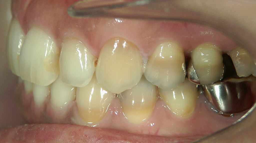 テトラサイクリン歯