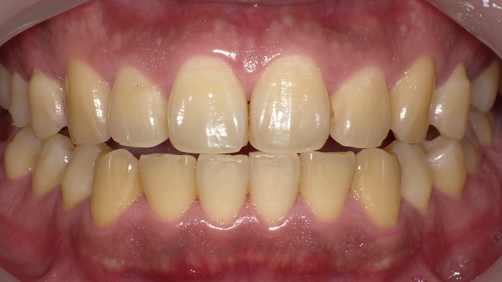 1枚目（ホワイトニング前）