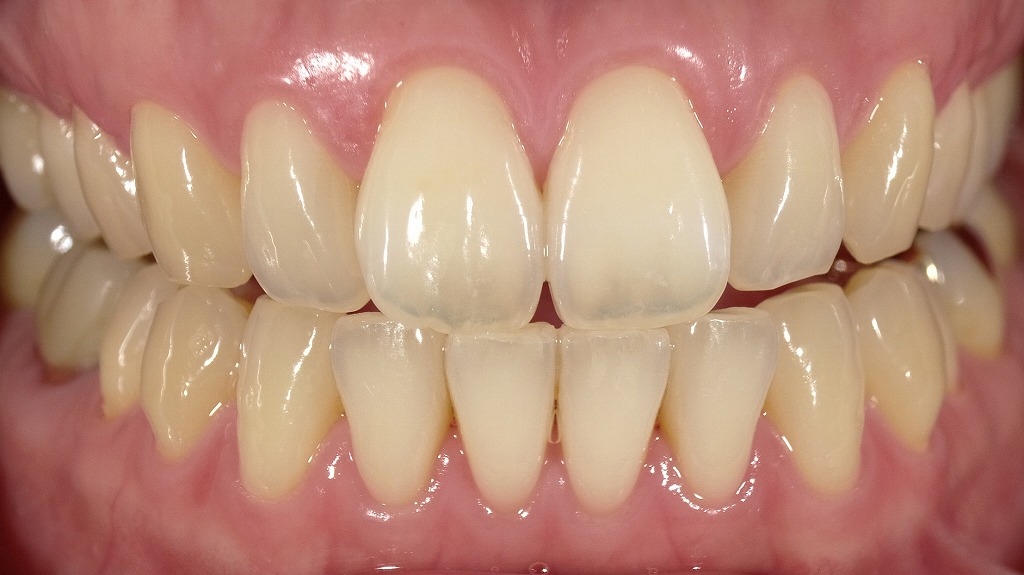 1枚目:ホワイトニング前