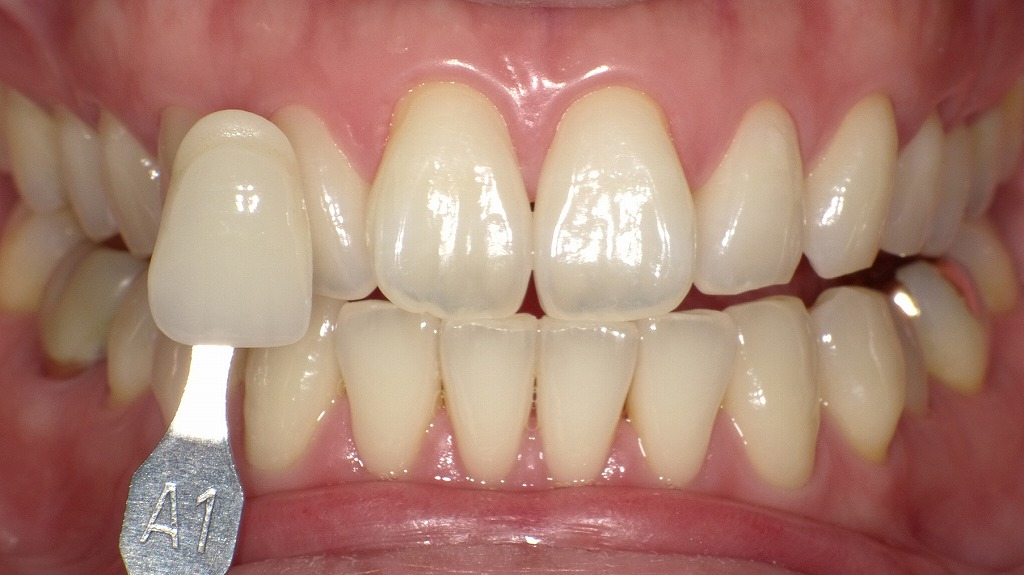 2枚目:ホワイトニング後