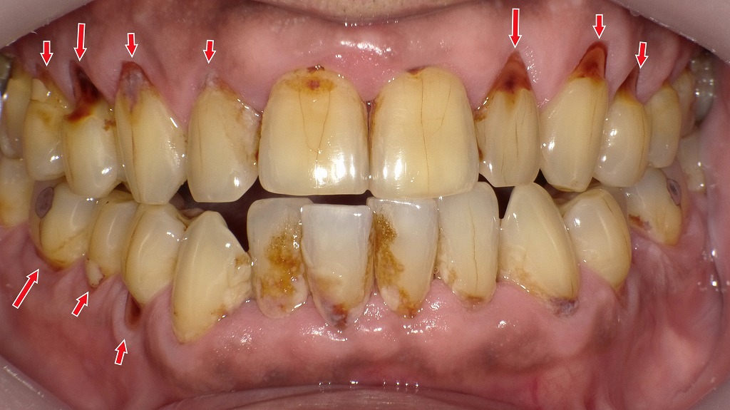 歯ぐきが下がり露出した根面に広がる根面う蝕。プラークと着色が重なり進行が分かりやすく示されています。