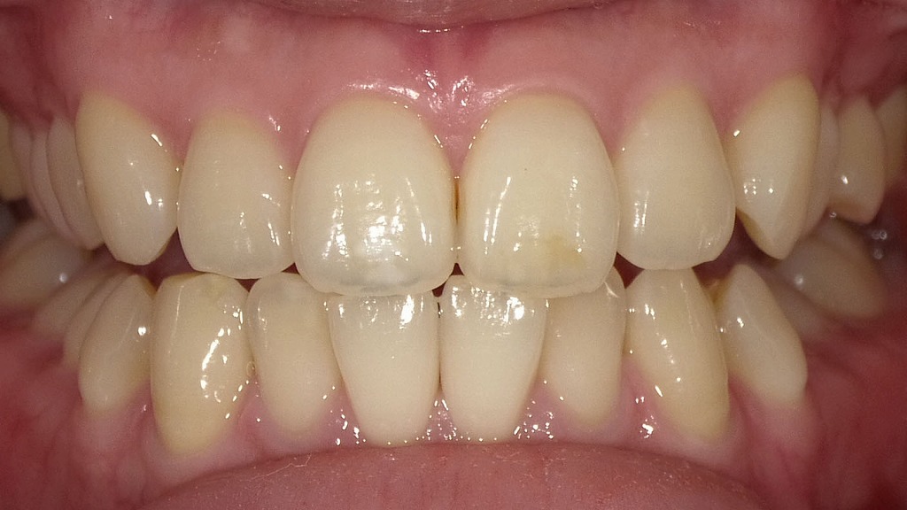 ホワイトニング前の前歯。エナメル質の透明感があり、歯本来の色調が確認できます。