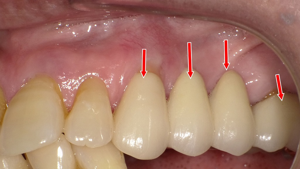 自然な透明感を再現したレイヤリングジルコニア補綴