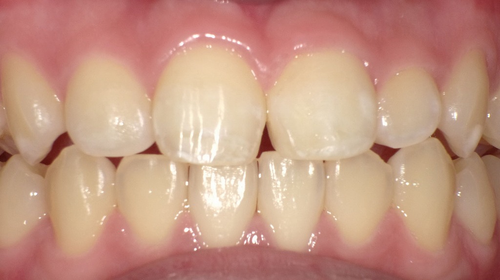 フッ素・MIペーストによる再石灰化｜初期虫歯（CO）の改善例