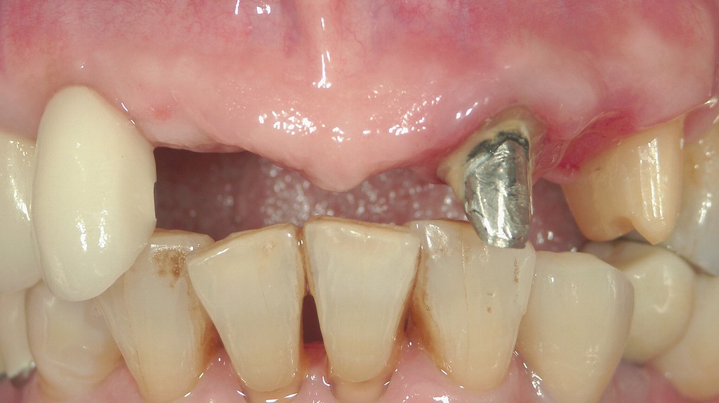 上顎前歯部欠損に対する抜歯後インプラント治療