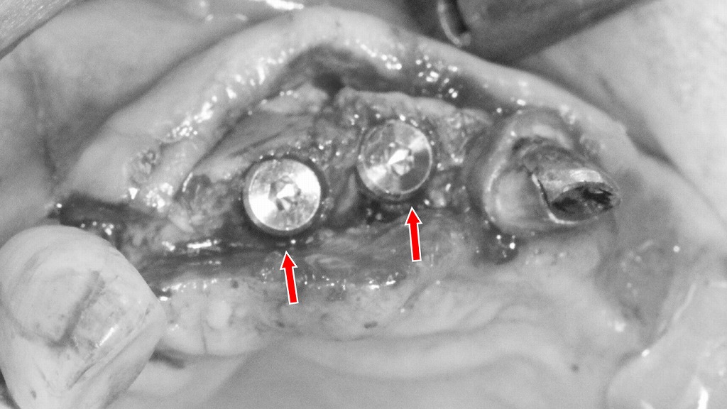 上顎前歯部欠損に対するインプラント埋入手術