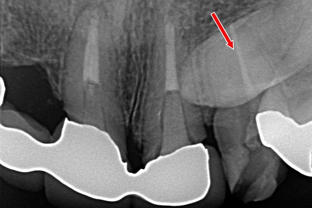 永久犬歯（矢印）が正しい位置に出てこられず埋伏している例