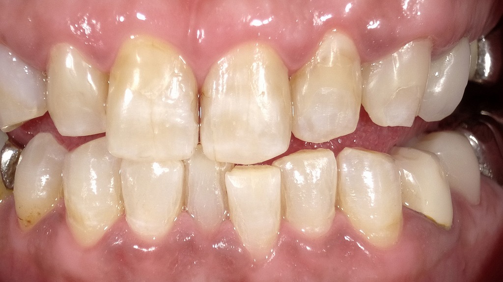 After： ホワイトニング後にレジンを新しくやり替え、明るく自然な前歯に改善