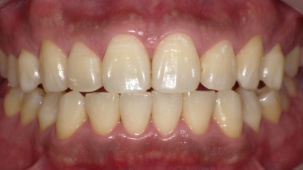 2枚目（ホワイトニング後）