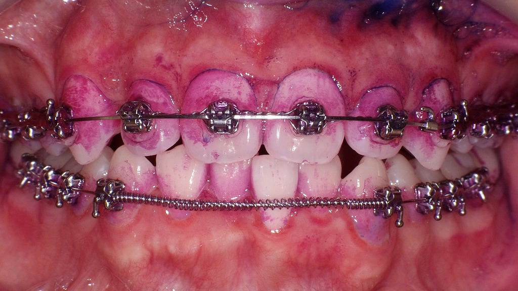 染め出しで発覚する“危険な磨き残し”