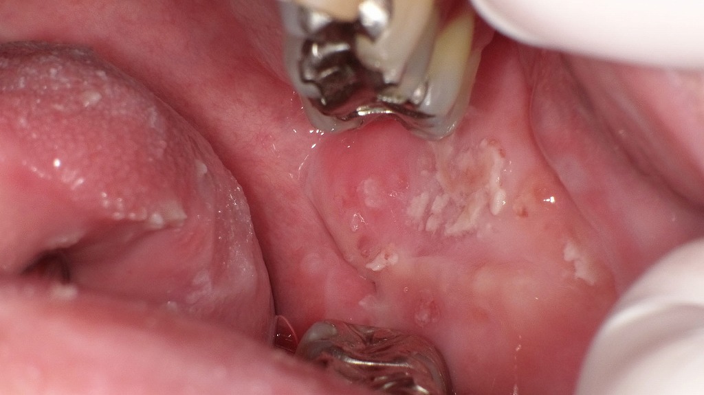 口腔カンジダ症による舌・頬粘膜の白苔と舌痛症の関連