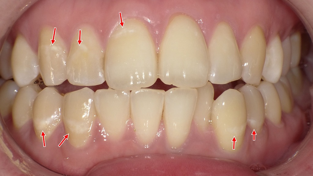 初期虫歯(C0)|削らずに経過観察できる段階のむし歯