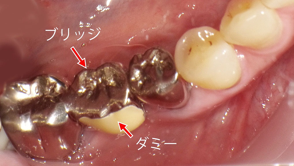 虫歯で抜歯後の治療法｜保険適用のブリッジ（5・6・7番）