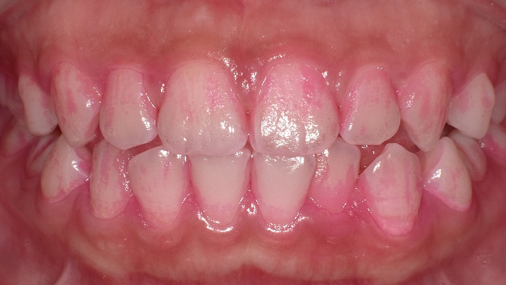 歯磨き指導後の改善：歯垢の付着が大幅に減少