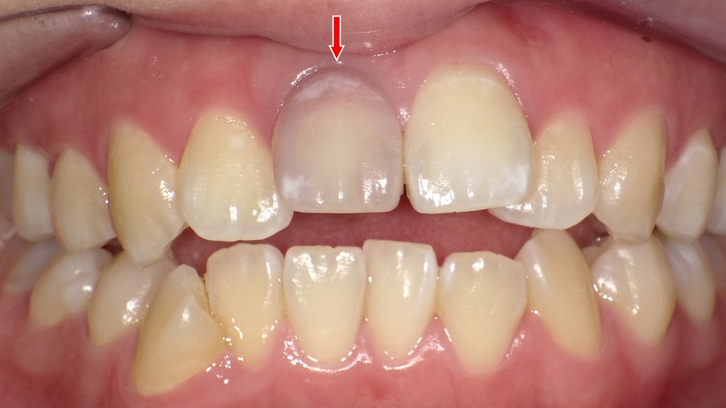 神経が死んだことで前歯が灰色に変色した状態。外傷や感染で歯髄が壊死すると、時間とともにこのような色調変化が起きます。