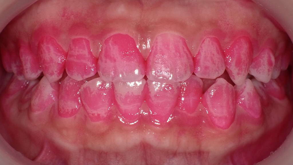 歯磨き粉だけでは不十分：歯周病対策の鍵は“正しいブラッシング”