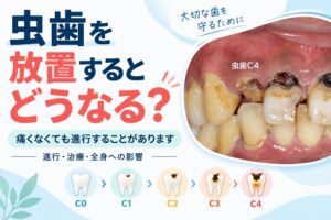 虫歯を放置するとどうなる？痛くない虫歯の進行と治療・全身への影響