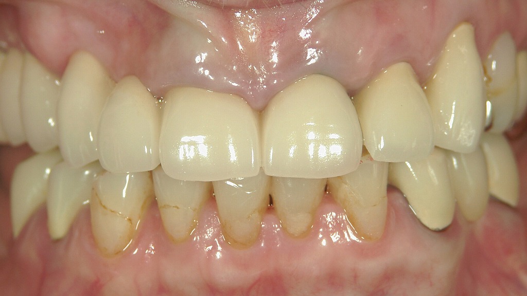 メタルタトゥーの症例：術後