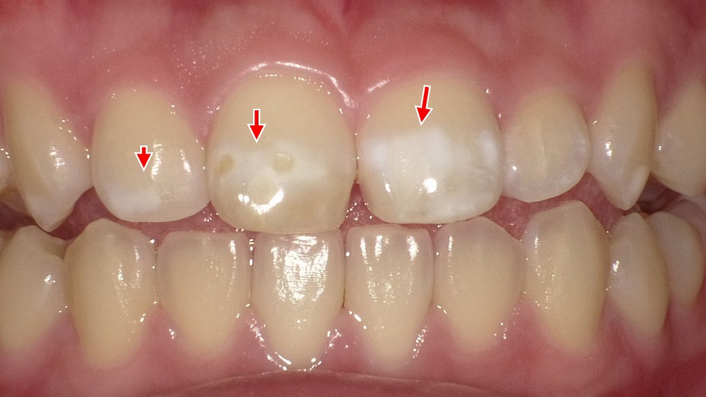初期の虫歯（CO）｜削らずに経過観察が可能な段階