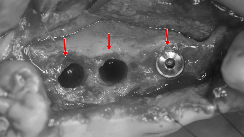 上顎4・5・6番部インプラント手術中の所見(4番埋入済み/5・6番埋入準備)