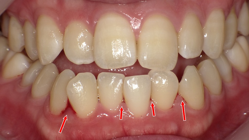 妊娠中のホルモン変化で歯ぐきが敏感になり、腫れや出血が起こりやすい状態です。