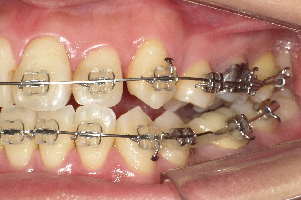 上4番・下5番抜歯後の歯列移動：ワイヤー矯正とパワーチェーンによる治療進行