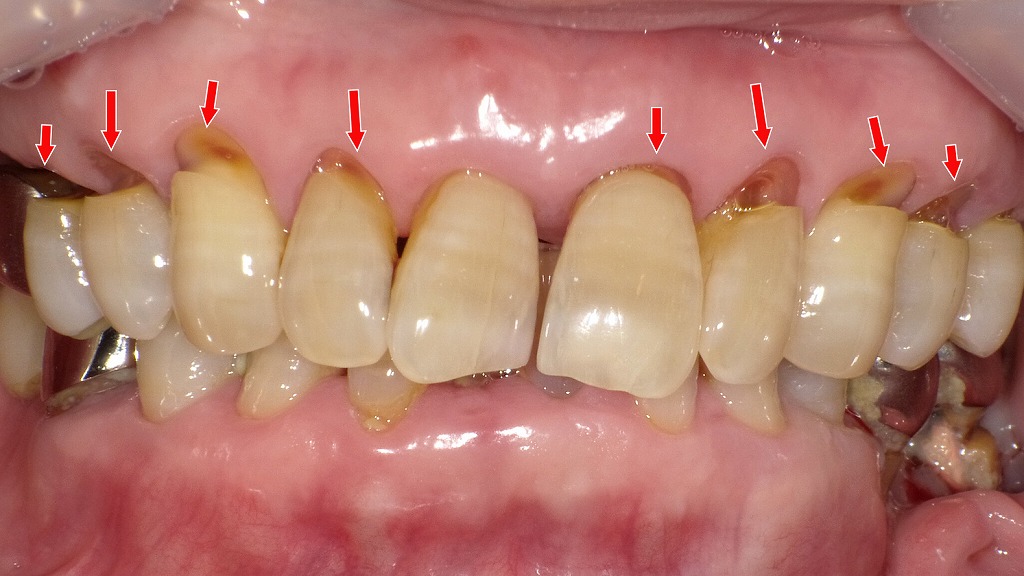 進行した楔状欠損