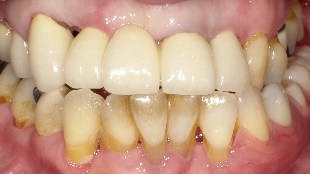 術後:黒い歯茎の治療例