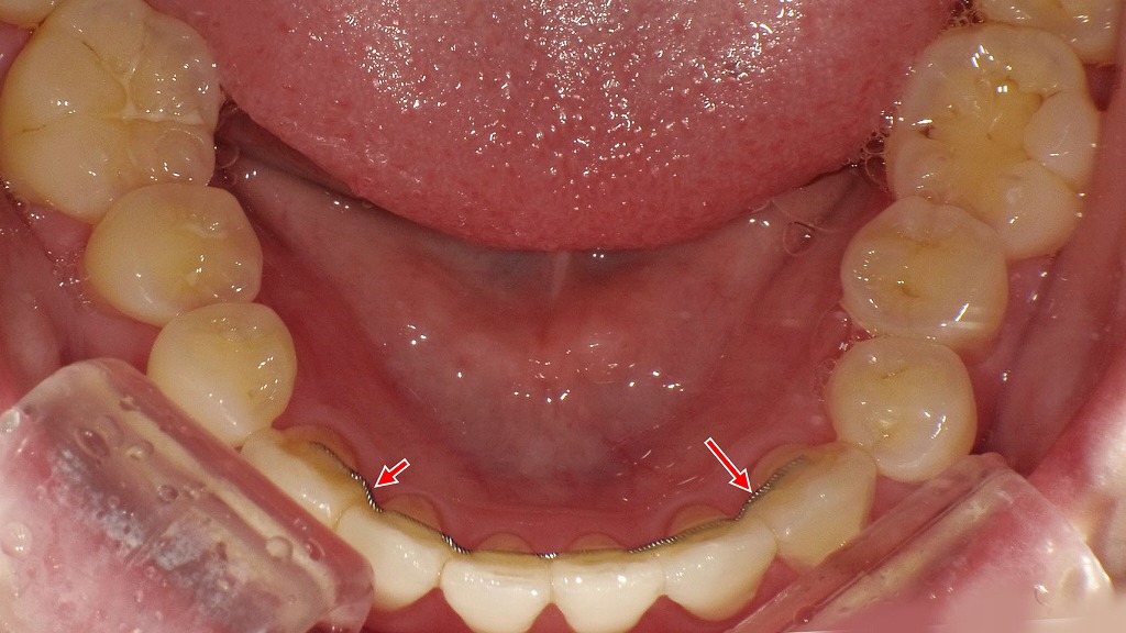 ワイヤー固定型の保定装置（リテーナー）