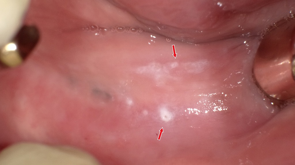 白くただれた粘膜が入れ歯の接触によって炎症を起こし、食事時に痛みが出ている状態です。