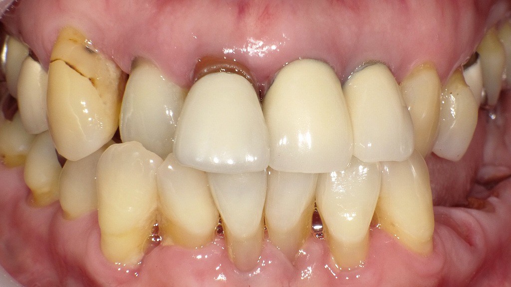 術前:黒い歯茎の治療例