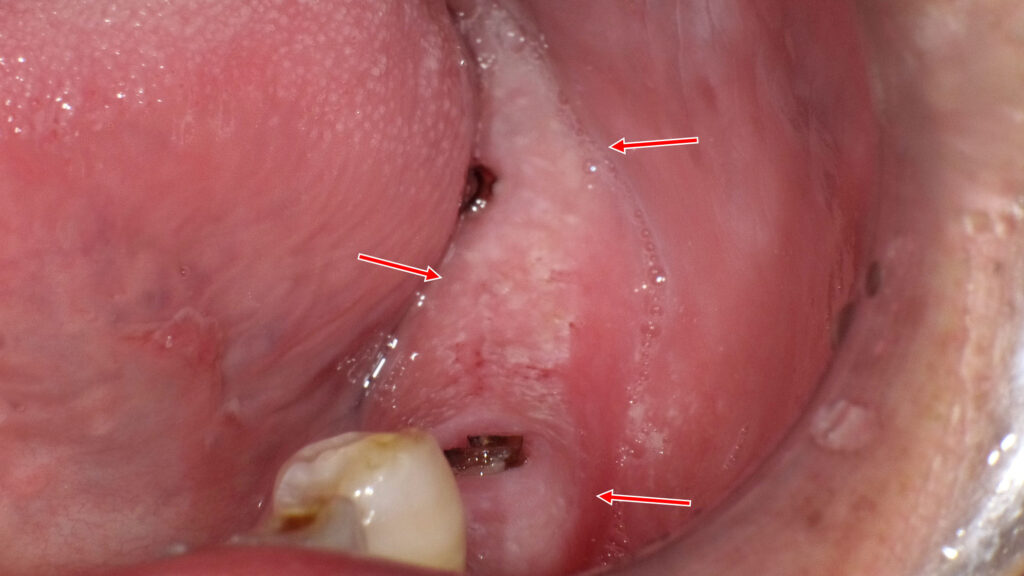 下顎歯槽堤にみられる口腔カンジダ症