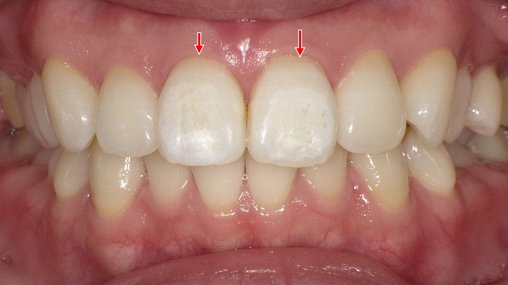 オフィスホワイトニング直後の状態。