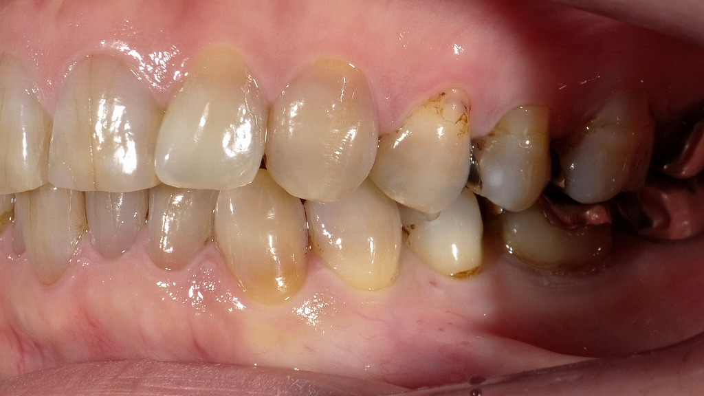 テトラサイクリン歯（抗生物質による変色歯）