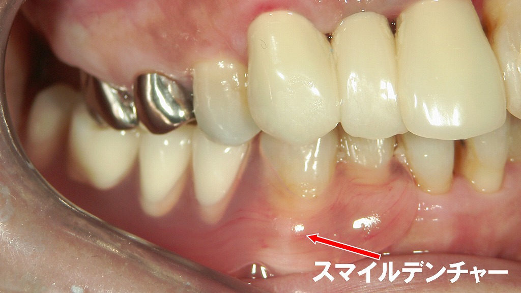 下顎4・5・6・7番部をカバーするスマイルデンチャー。金属バネを使わず、違和感を抑えながら奥歯の噛む力を補います。